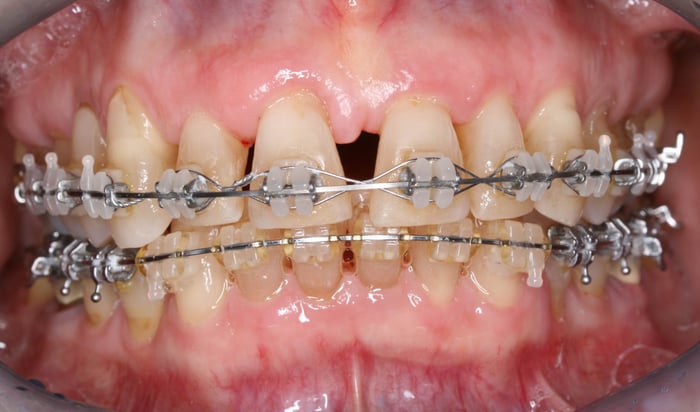 ortodoncia-pacientes-periodontitis-posible2