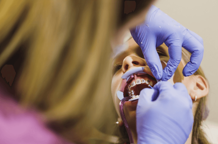 consecuencias-de-brackets-mal-colocados-errores-problemas-periodontales
