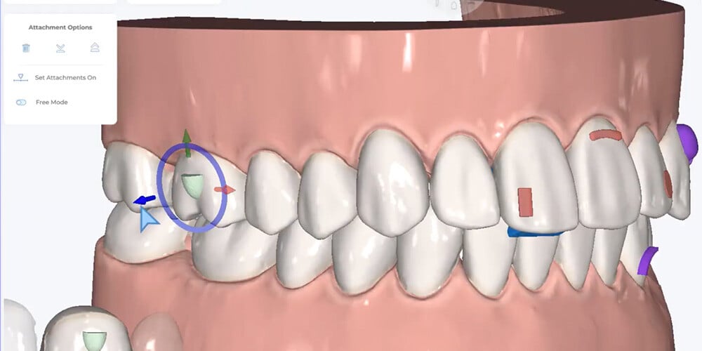 aditamentos-dentales