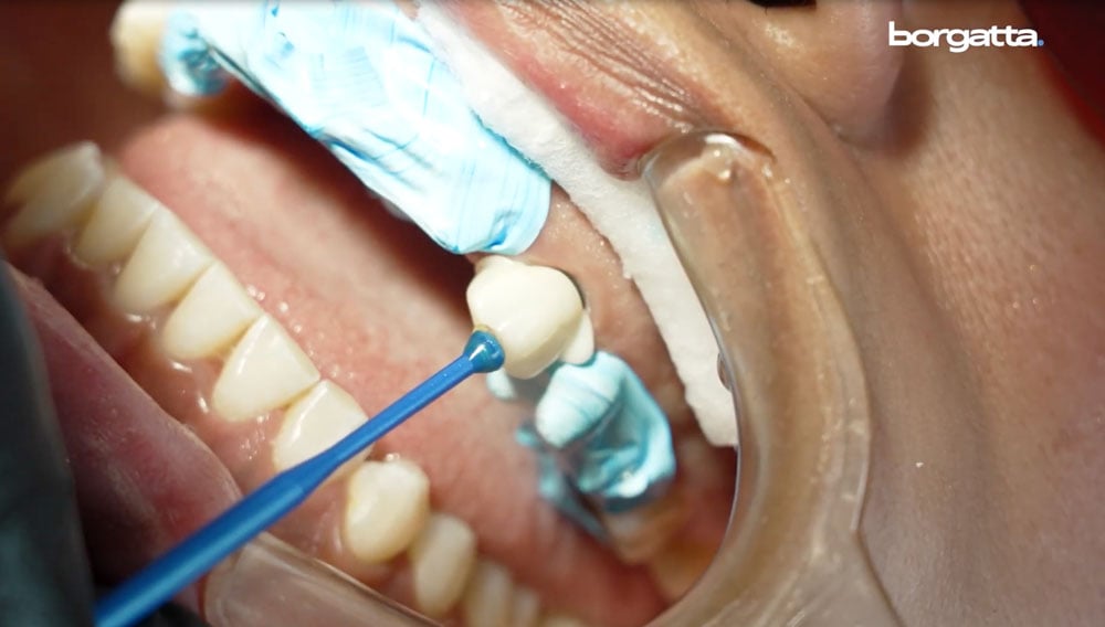 con-que-cementa-zirconia