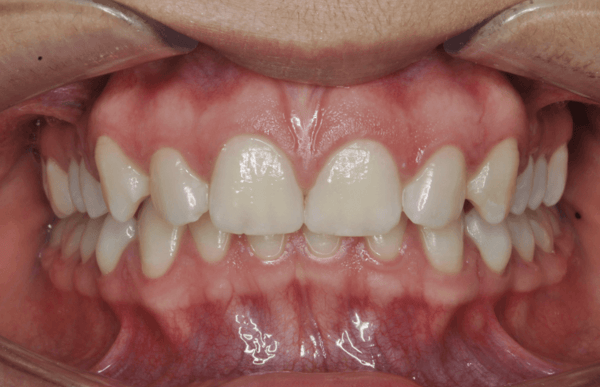 resolver-una-mordida-profunda-con-ortodoncia-cco-smile-system-consideraciones-iniciales