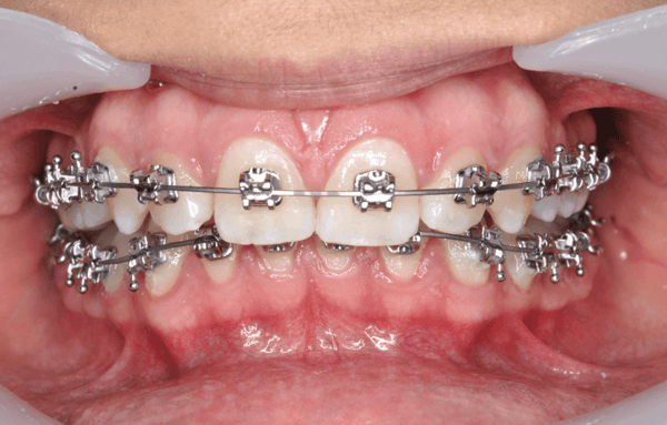 resolver-una-mordida-profunda-con-ortodoncia-cco-smile-system-desafios