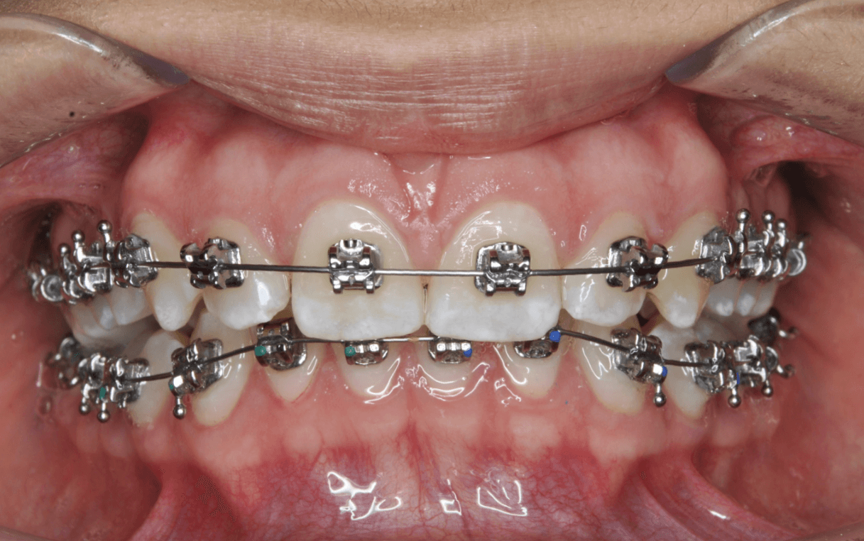 resolver-una-mordida-profunda-con-ortodoncia-cco-3