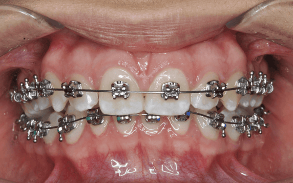 resolver-una-mordida-profunda-con-ortodoncia-cco-smile-system-diagnostico