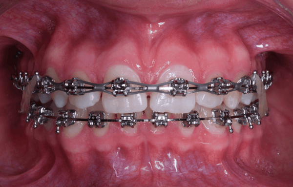 resolver-una-mordida-profunda-con-ortodoncia-cco-smile-system-estabilidad-oclusal