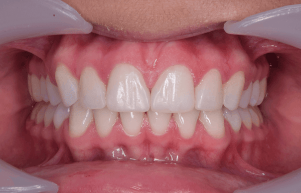 resolver-una-mordida-profunda-con-ortodoncia-cco-smile-system-intervencion-en-ninos
