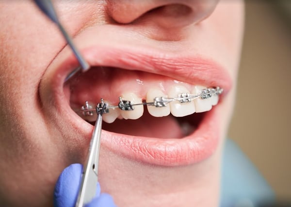Arco dental en tratamientos de ortodoncia, ¿para que sirve?