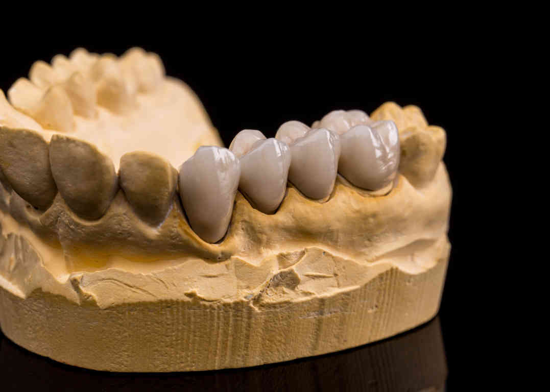 Coronas de zirconio: ventajas y desventajas