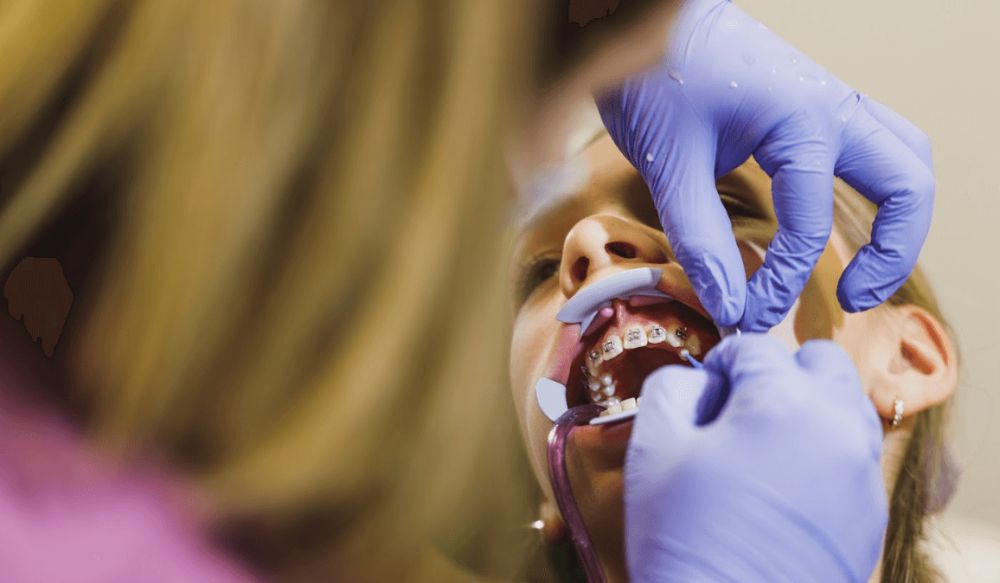 Foro: ¿Cómo evitas errores en el cementado de brackets?