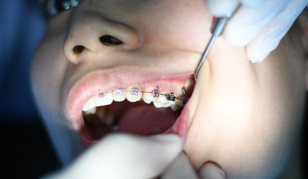 Foro: ¿En qué te fijas al elegir la técnica de brackets para tu consultorio?