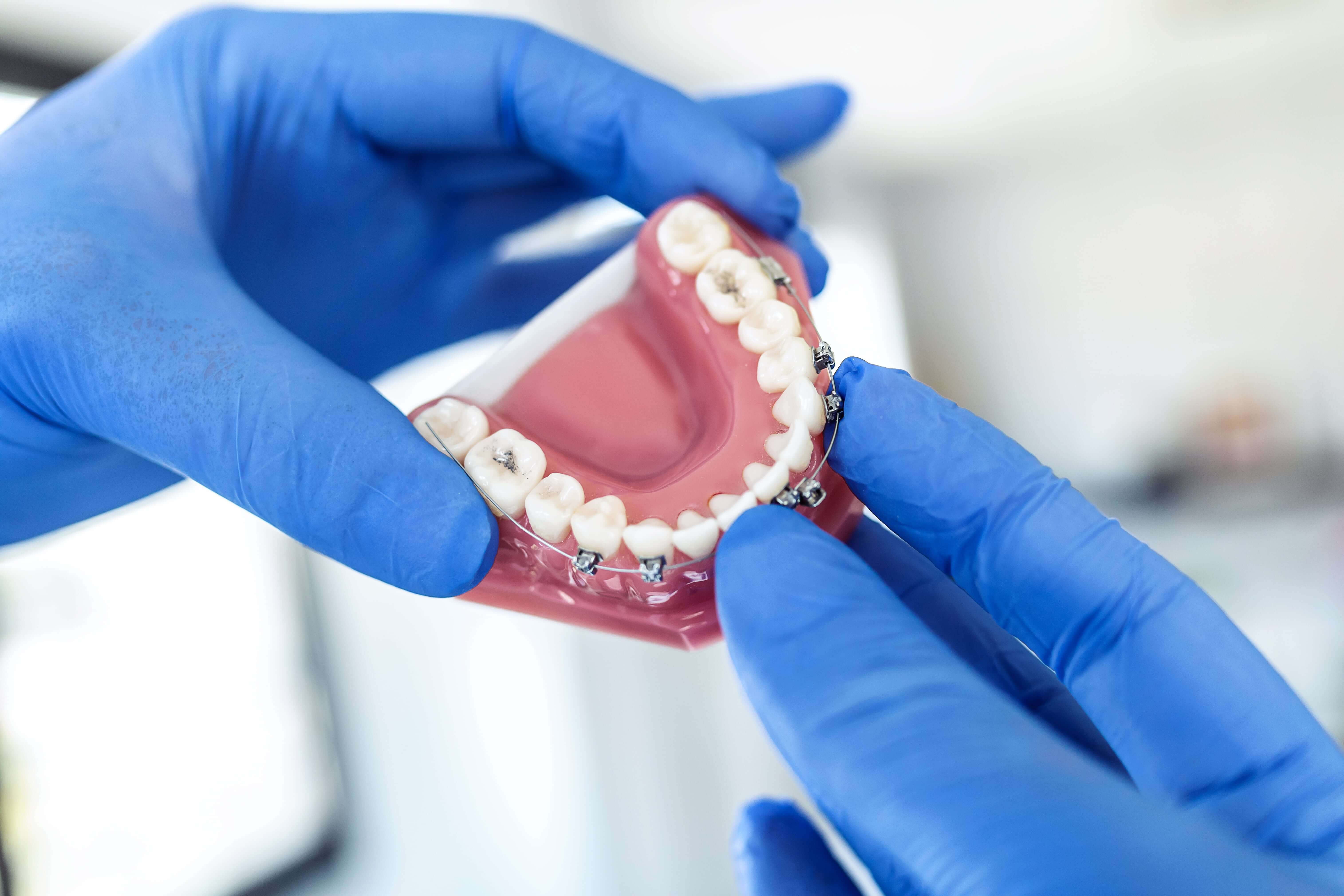 ¿Cómo elegir la mejor marca de brackets autoligables? Guía para ortodoncistas