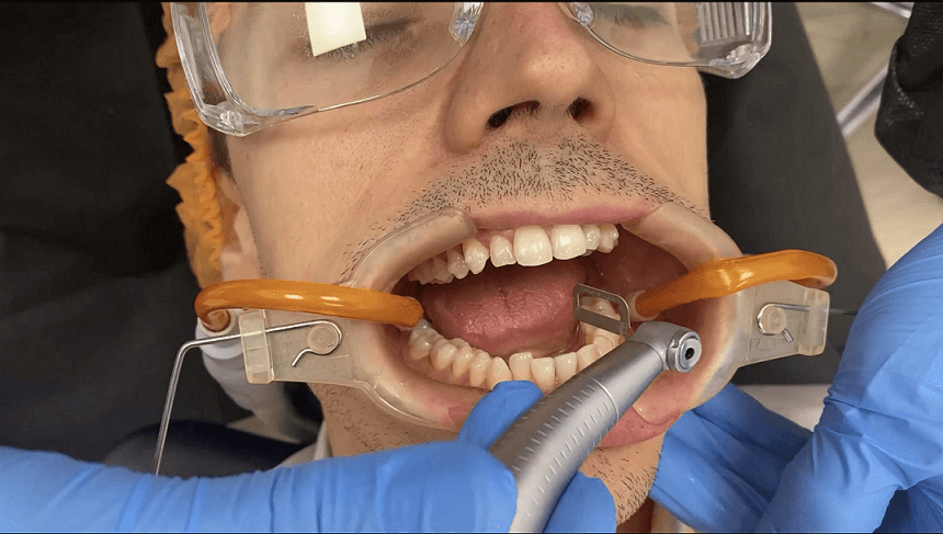 Stripping dental en ortodoncia, ¿qué es y para qué lo utilizamos?