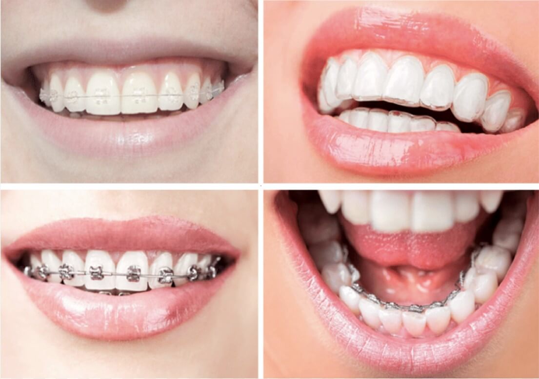 ¿Cuáles son los mejores brackets en ortodoncia?