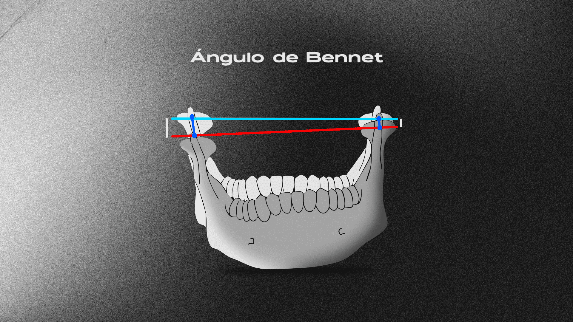 Qué es el ángulo de Bennett y su importancia en Ordodoncia