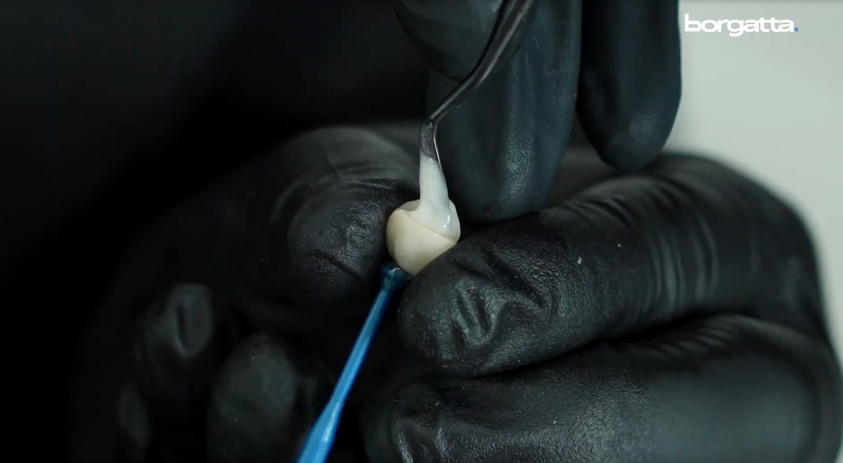 Cementación de zirconia; protocolo de cementación