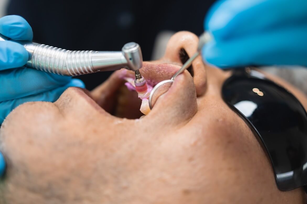 Cementar brackets: tips para usar resina para pegar brackets