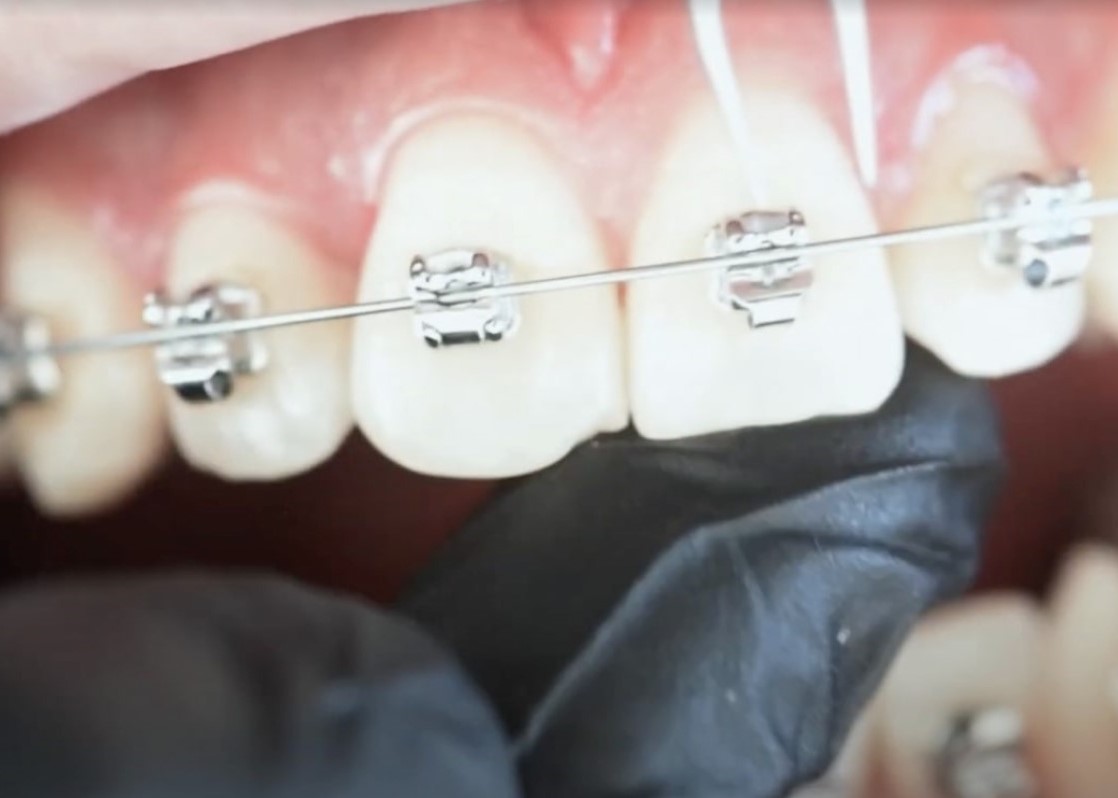 Tratamientos según tipo de maloclusión dental